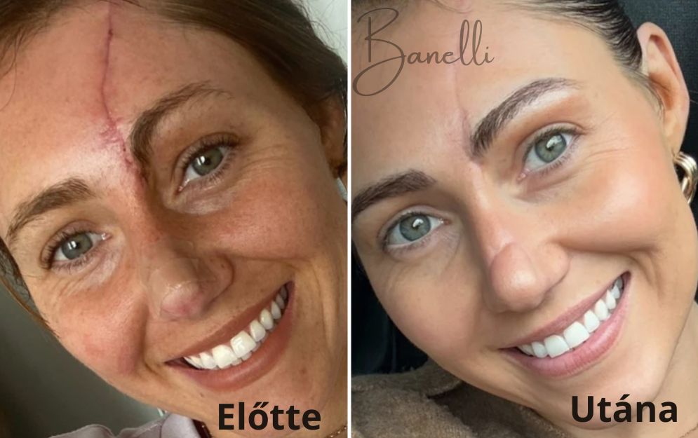 Vezeték Nélküli Fényterápiás Arcmaszk