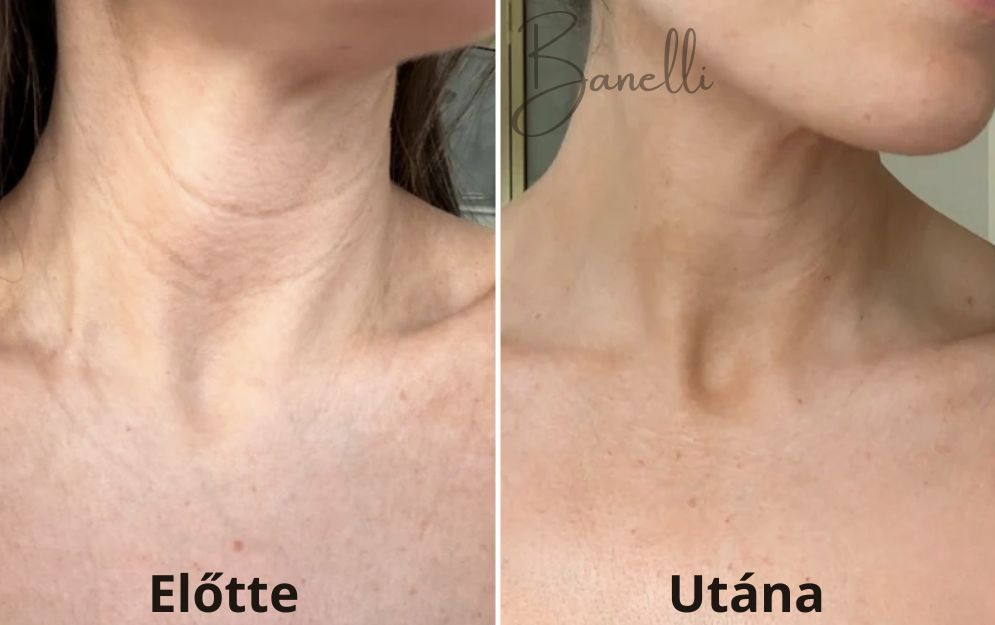 Vezeték Nélküli Fényterápiás Nyakmaszk