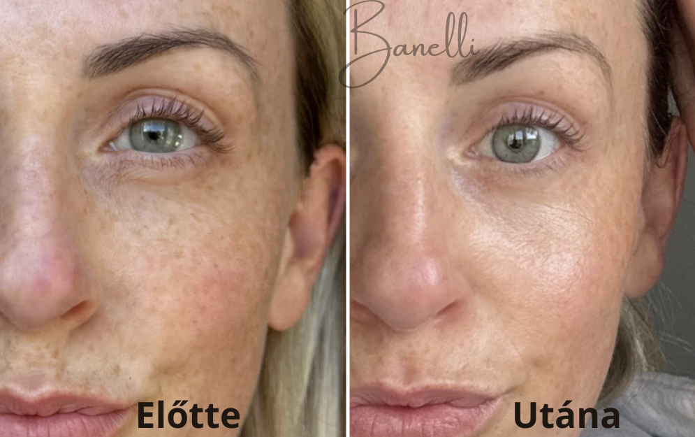 Vezeték Nélküli Fényterápiás Arcmaszk